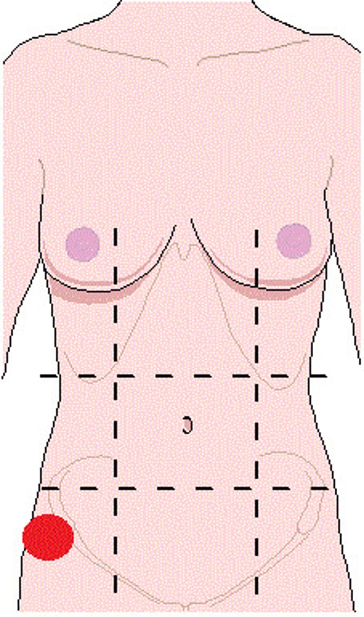 <p>Location:</p><p>Abdominal wall (anterior)</p><p>Description:</p><p>One of nine regions of abdominal cavity</p><p>Right lower lateral region</p><p>Contents include parts of small and large intestine (including cecum and vermiform appendix)</p>