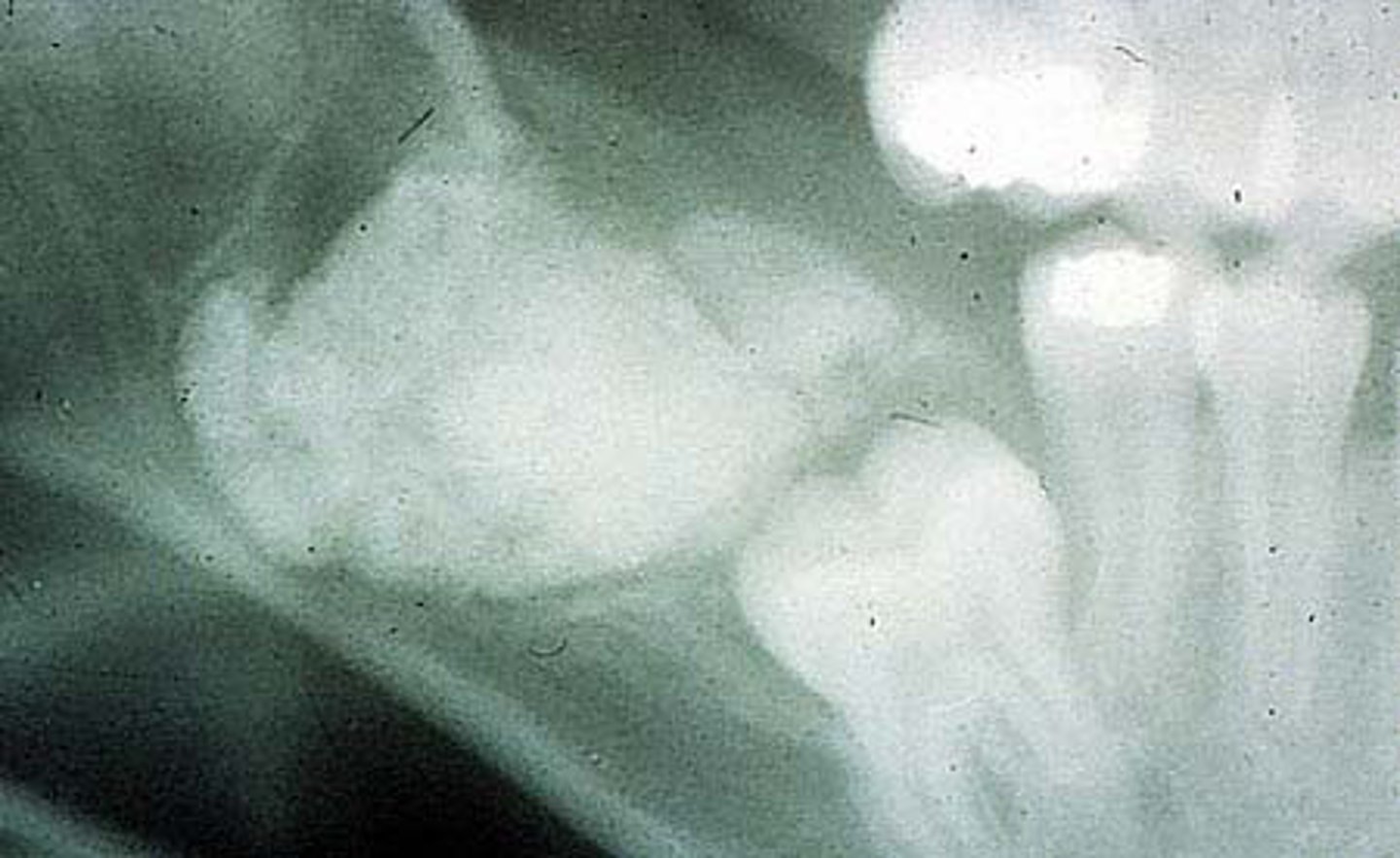 <p>contains odontogenic tissues but doesn't form small tooth-appearing structures</p>