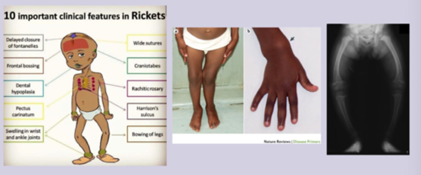 <p>Osteomalacia </p><p>-diffuse bone pain in hip, pelvis, lower back </p><p>-muscle weakness, waddling gait</p><p>-fragility with minimal trauma </p><p>-tenderness over bones</p><p>Rickets </p><p>-delayed motor milestones</p><p>-bone pain in legs and spine </p><p>-growth delay, dental problems</p><p>-seizures, tetany </p><p>-craniofacial deformities, rachitic rosary, harrison groove, widening wrist</p>