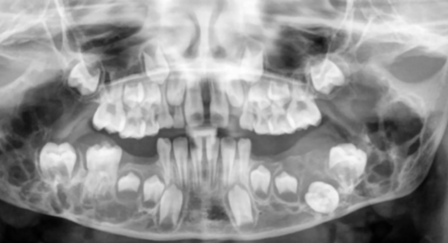 <p>bilateral multilocular lucencies</p>