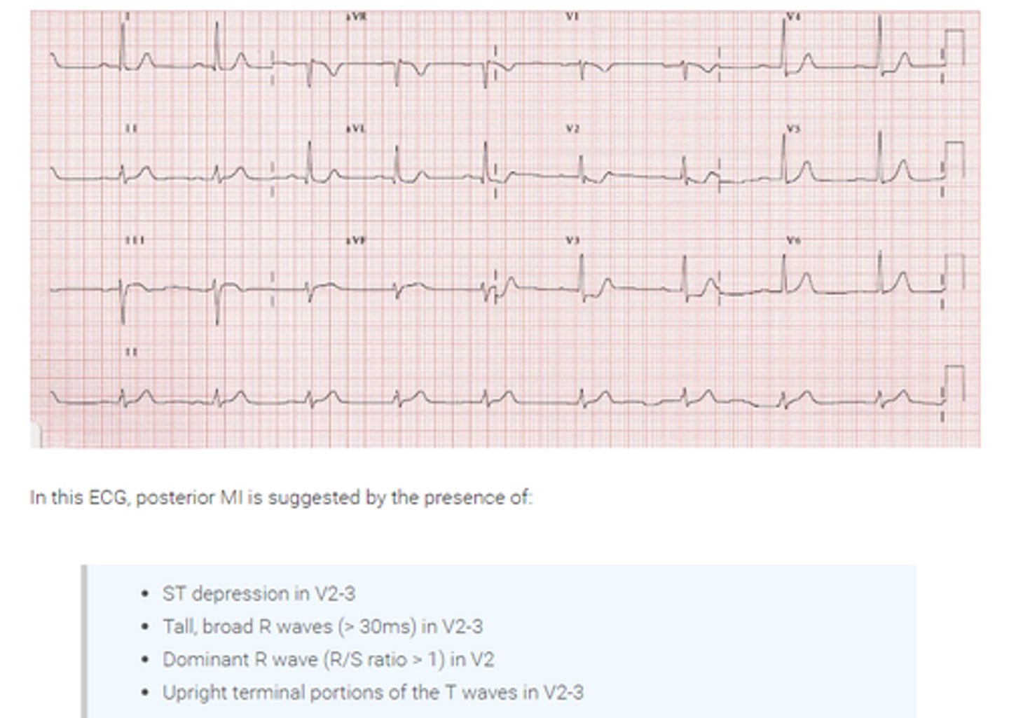 <p>- horizontal ST segment depression and upright T waves in V1 and V2</p><p>- dominant R waves in V2 (R/S ratio &gt;1)</p><p>- ST segment elevation in V7-V9</p>