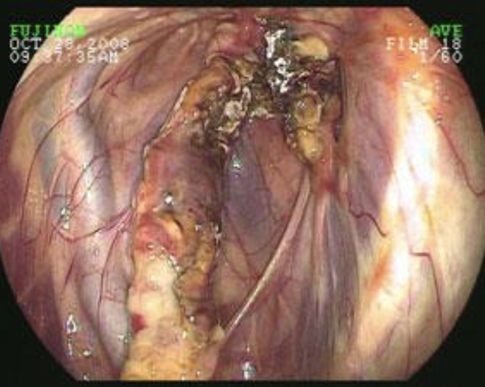 <p>sudden non-exertional associated epistaxis, mild to profound</p><p>usually unilateral</p>