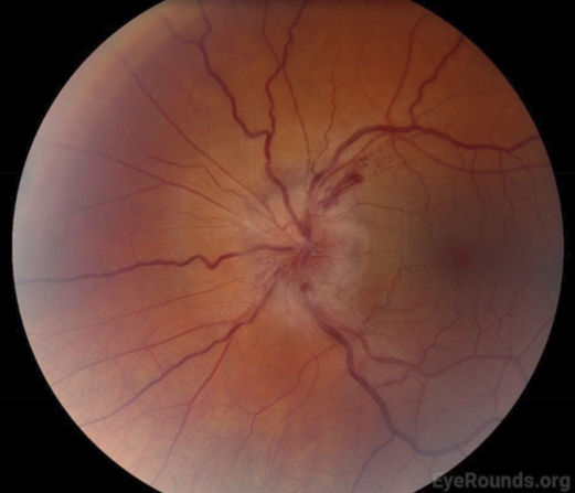 <p>Ischemia of the optic head that is not caused by GCA.</p>