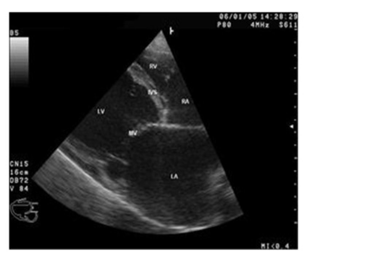 <p>CHF (congestive heart failure)</p>