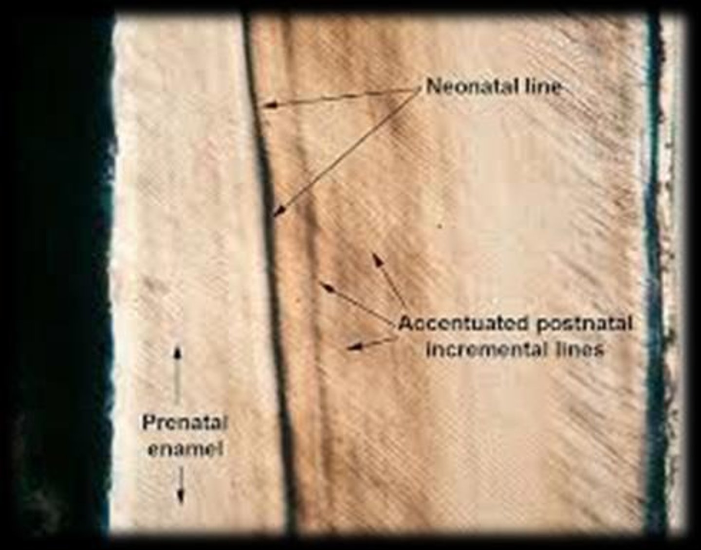 <p>Surface manifestations of Striae of Retzius that are horizontal in direction, seen on the labial surface of anterior teeth.</p>