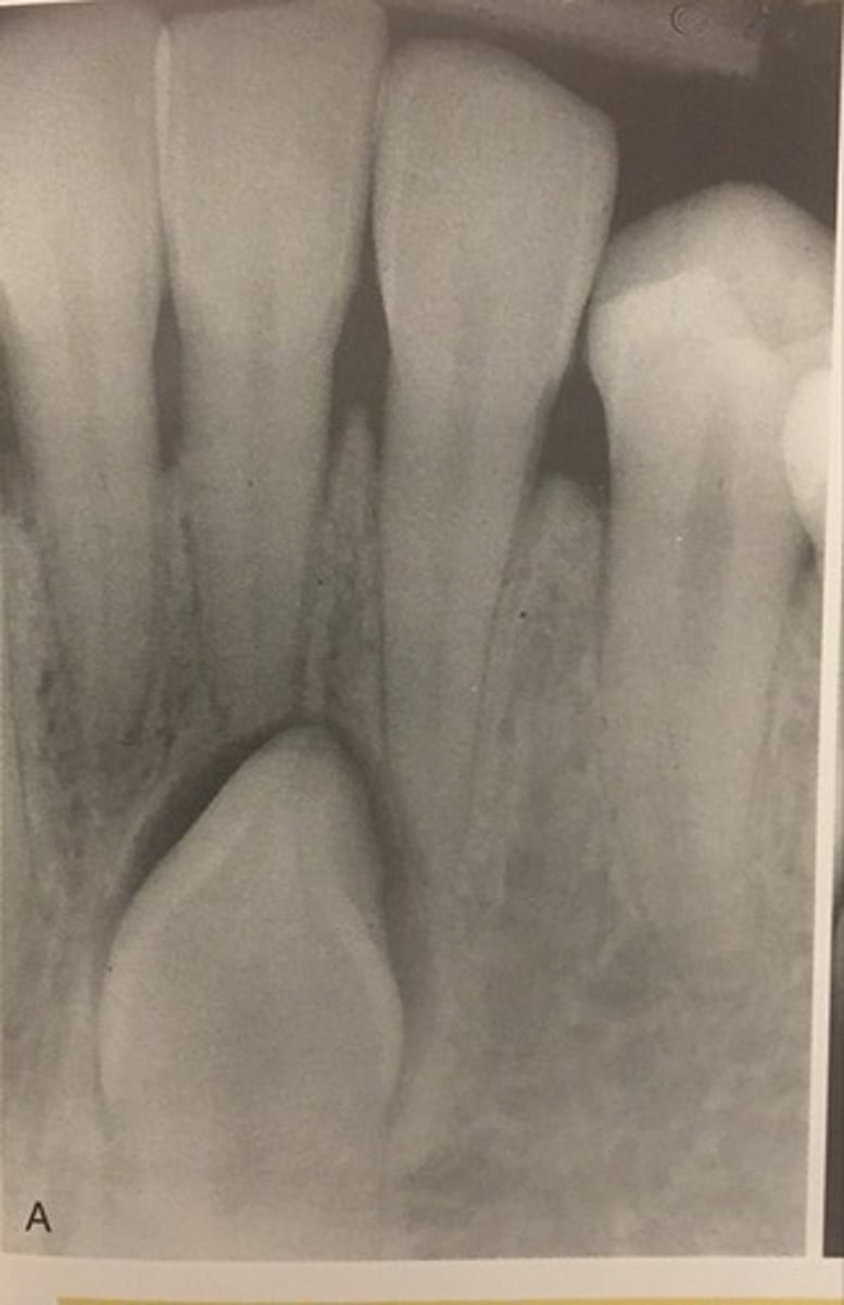 <p>impacted tooth</p><p>- verify all teeth are present, if primary tooth is present without succedaneous, impacted tooth is likely.</p><p>- I had a lot of odontoma questions; look for 'mini teeth' in the radiopaque mass to diagnose compound odontomas</p>