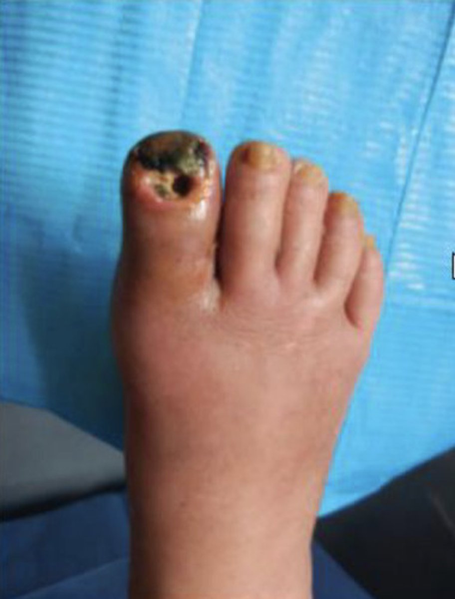 <p>What type of necrosis is seen in this image?</p>