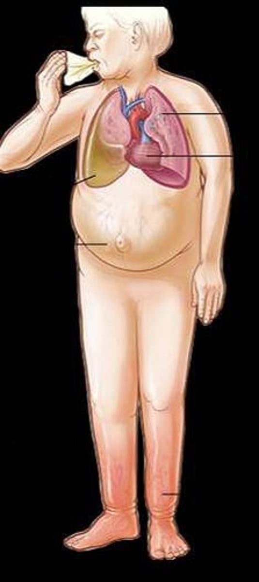 <p>Weight gain, decreased BP, increased HR.</p>