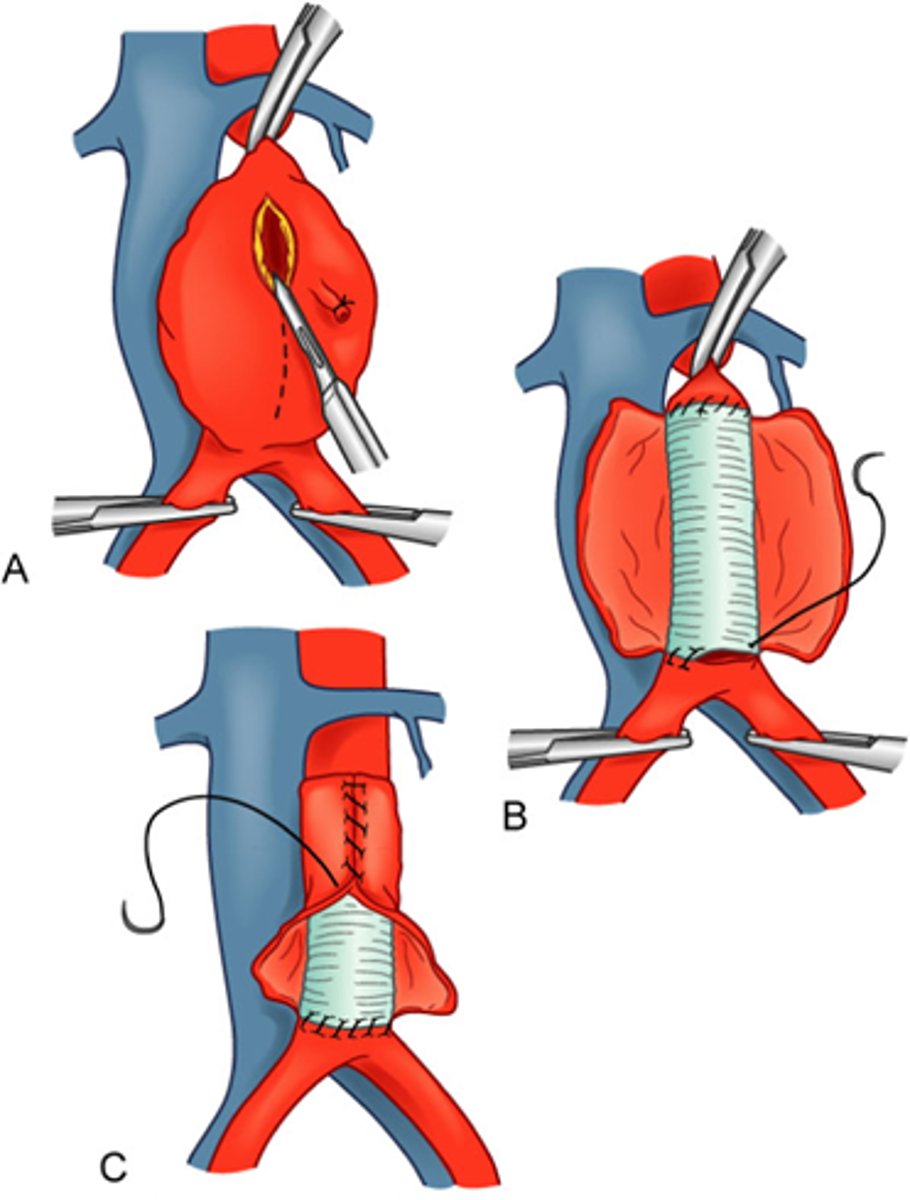 <p>clamp above and below aneurysm, place graft &amp; remove existing plaques, remove clamps; if renal arteries are clamped, you may permanently damage the kidneys</p>