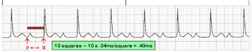 <p>What type of heart block is shown in this EKG? </p>