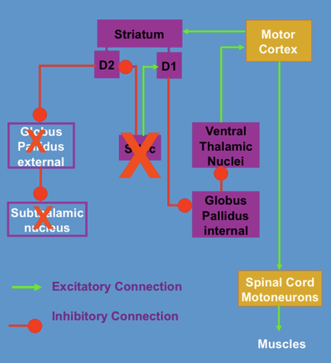 <p>lesion in globus pallidus, so theres less neurons inhibiting thalamus (lets movement occur)</p>