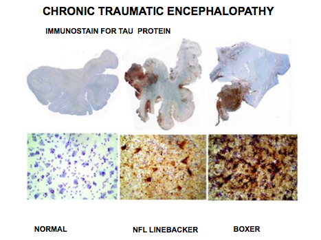 A progressive degeneration, and/or death, of nerve cells caused by repeated head injuries, such as repeated concussions.