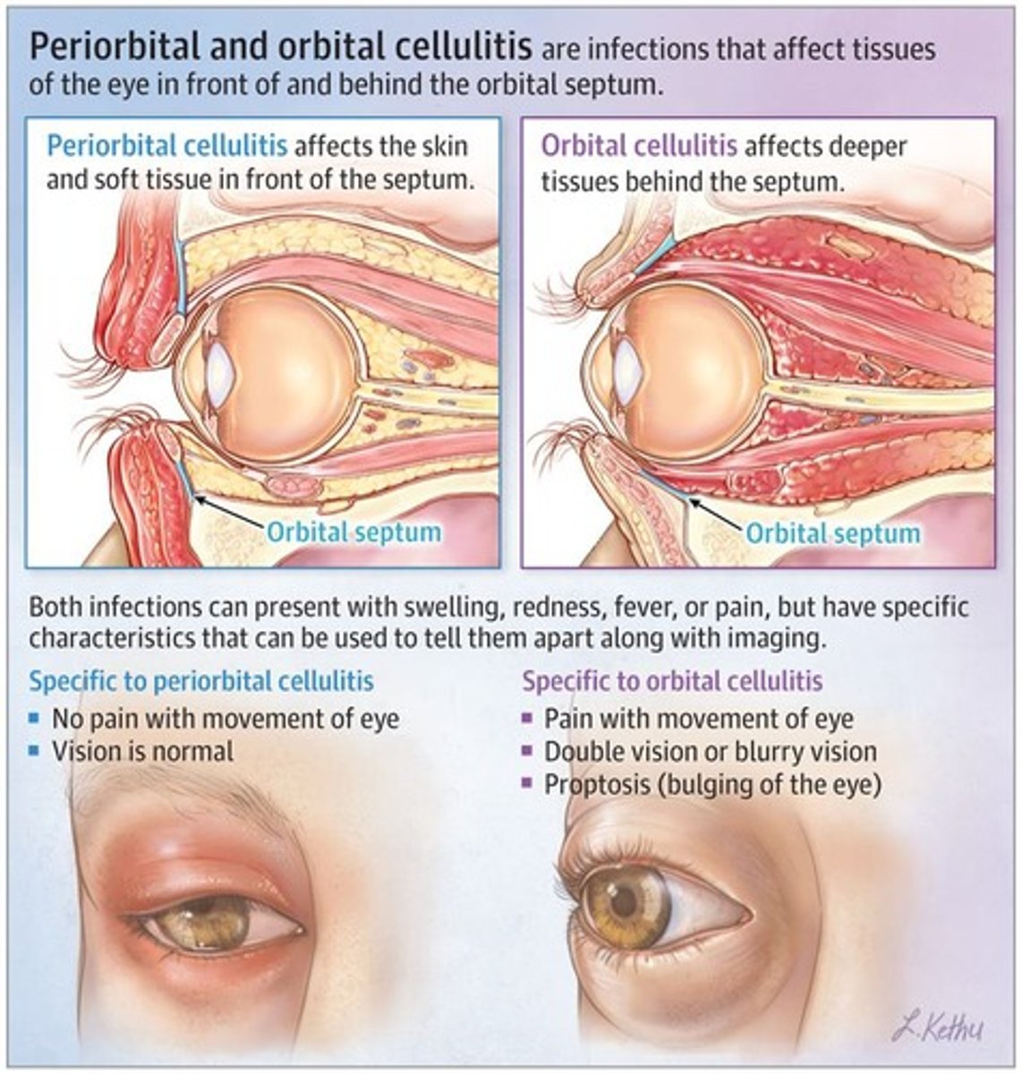 <p>Orbital has Pain with Eye Movement, Proptosis, and Ophthalmoplegia (Preseptal does not)</p>