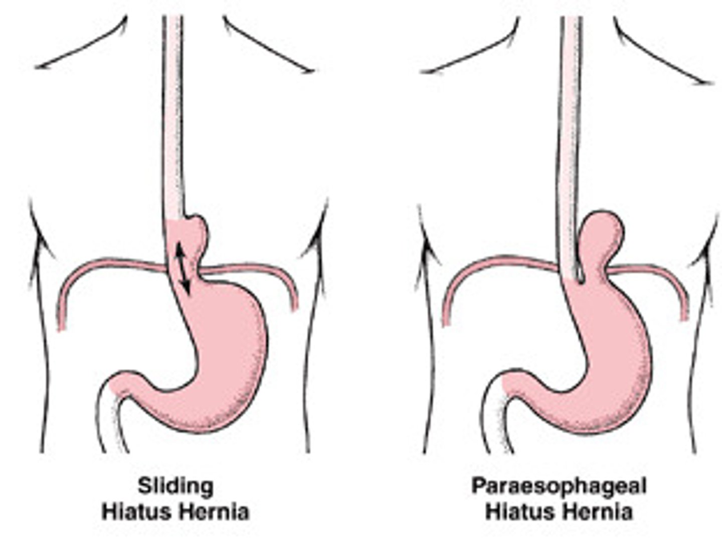 <p>Sliding (1) is the constant wear and tear of the GEJ leading to widening of hiatal tunnel allowing sphincter and top part of the stomach upwards towards the chest</p><p>Rolling (2) is an anatomical defect causing improper anchoring of the stomach below the diaphragm</p>