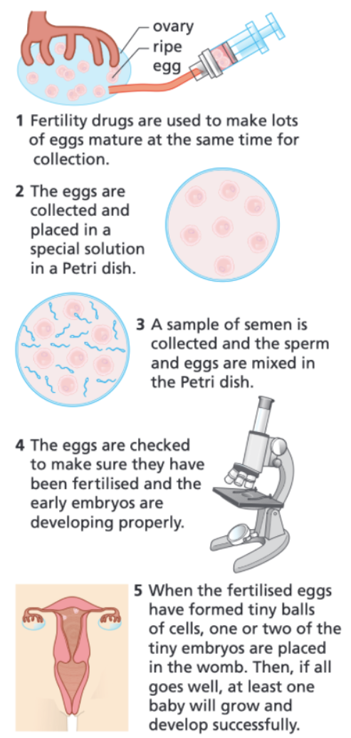 <ul><li><p>IVF involves giving a mother FSH and LH to stimulate the maturation of several eggs.</p></li><li><p>The eggs are collected from the mother and fertilised by sperm from the father in the laboratory.</p></li><li><p>The fertilised eggs develop into embryos.</p></li><li><p>At the stage when they are tiny balls of cells, one or two embryos are inserted into the mother's uterus (womb).</p></li></ul><p></p>