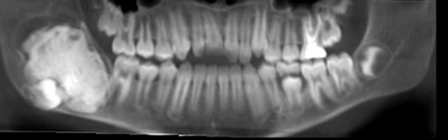<p>more likely to occur in the posterior regions of the jaw</p><p>asymptomatic and usually discovered by accident</p><p>associated with delayed/asymmetric tooth eruption</p><p>xray- well circumscribed, mixed radiolucencies and radiopacities</p>