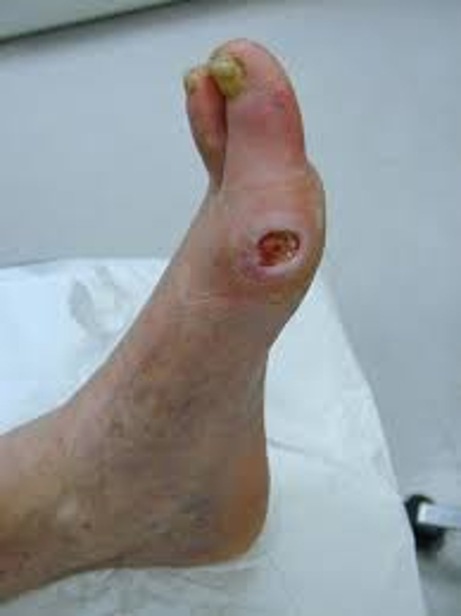 <p>TESTING:</p><p>- pulses, rubor dependency, claudication, ABI</p><p>- exudate assessment</p><p>DEBRIDEMENT:</p><p>- NO sharp</p><p>(leave dry stable eschar intact)</p><p>- enzymatic or autolytic to remove necrotic tissue</p><p>DRESSING:</p><p>- "wet" dressing to add moisture to dry wound</p><p>MODALITIES:</p><p>- e-stim, MIST ultrasound, infrared, hyperbaric O2</p><p>PT:</p><p>- walking program, LE strengthening </p>