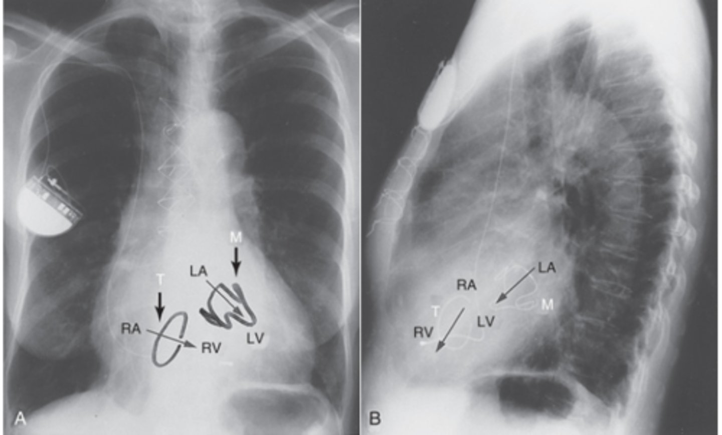 <p>- The mitral valve is posteriorly and to the left side</p><p>- The tricuspid valve is anterior and toward the right side</p>