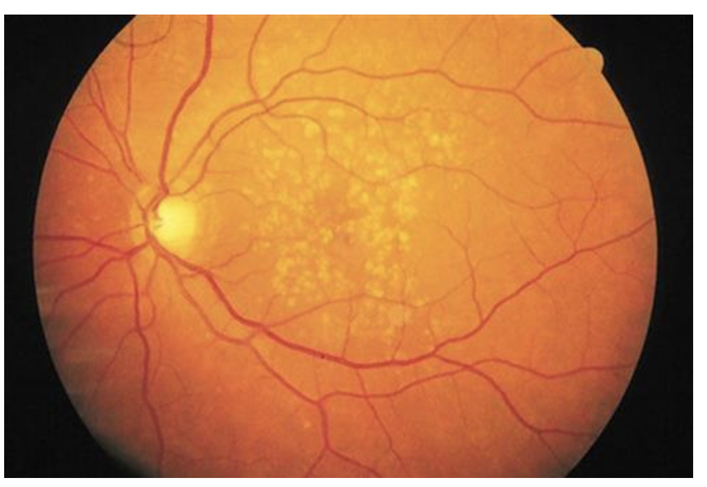 <p>Reduced vision and this?</p>