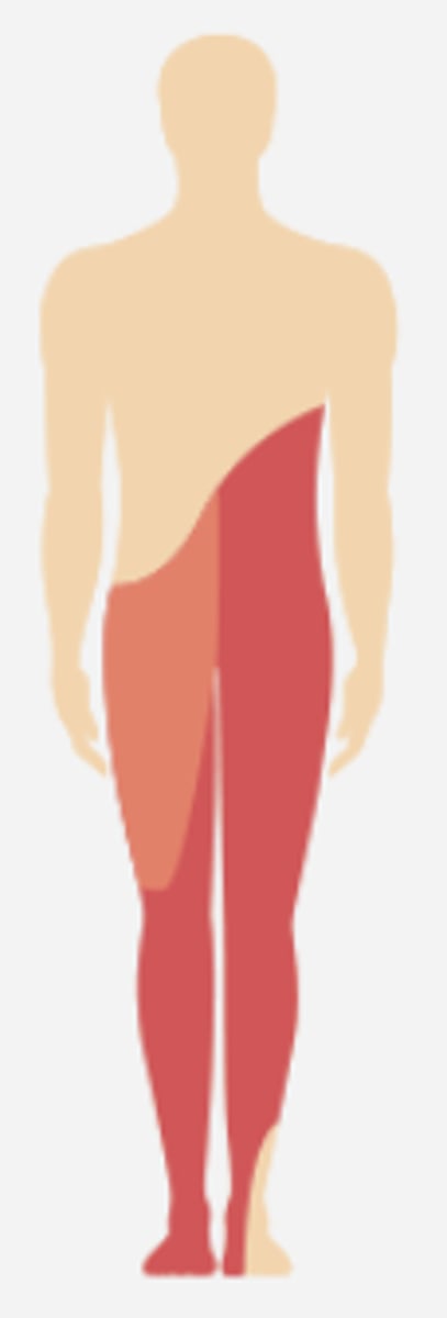 <p>% of incomplete paraplegia cases</p>