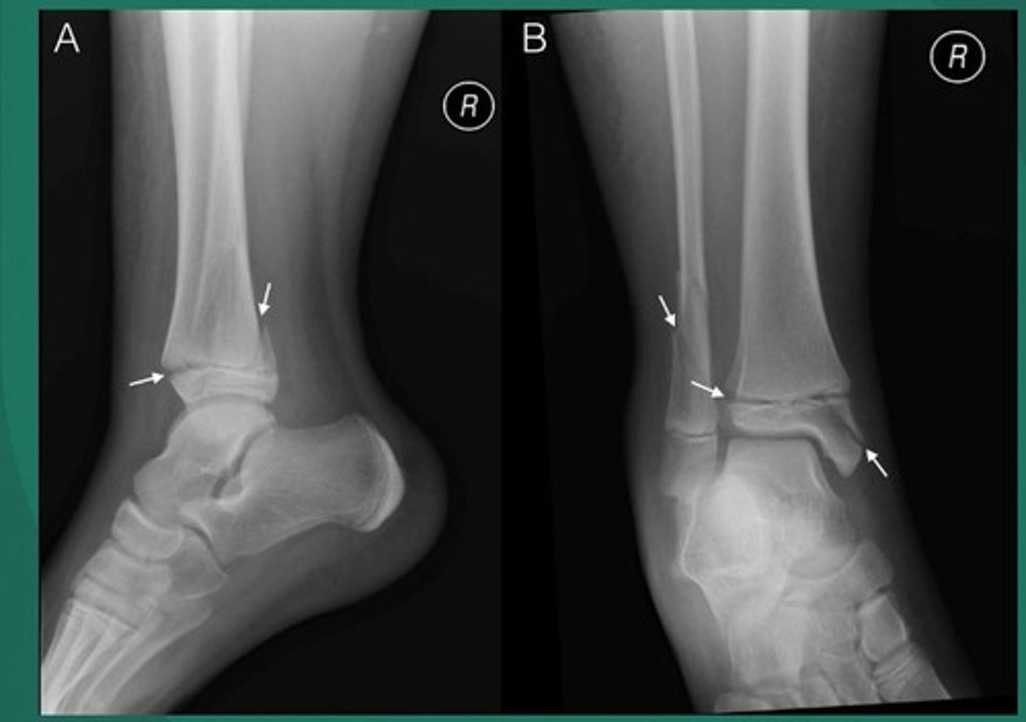 <p>Jones fracture, epiphyseal fracture, stress fracture.</p>