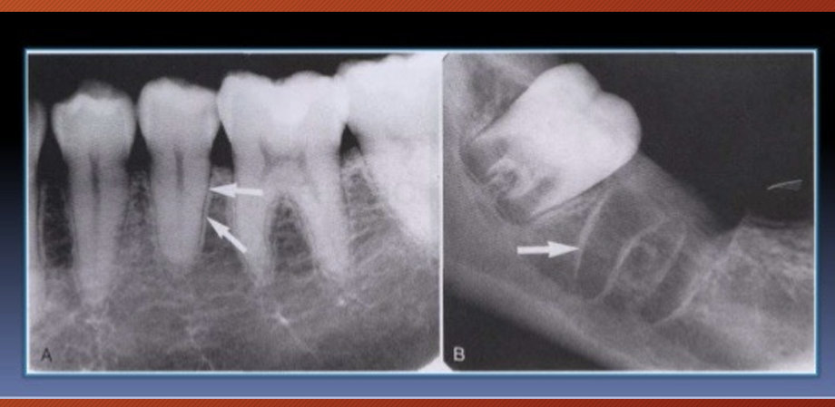 <p>it is a thin radiopaque layer of dense bone - cortical bone - surrounding the tooth socket</p><p>it is thicker than the surrounding trabecular bone - hence appears whiter</p>