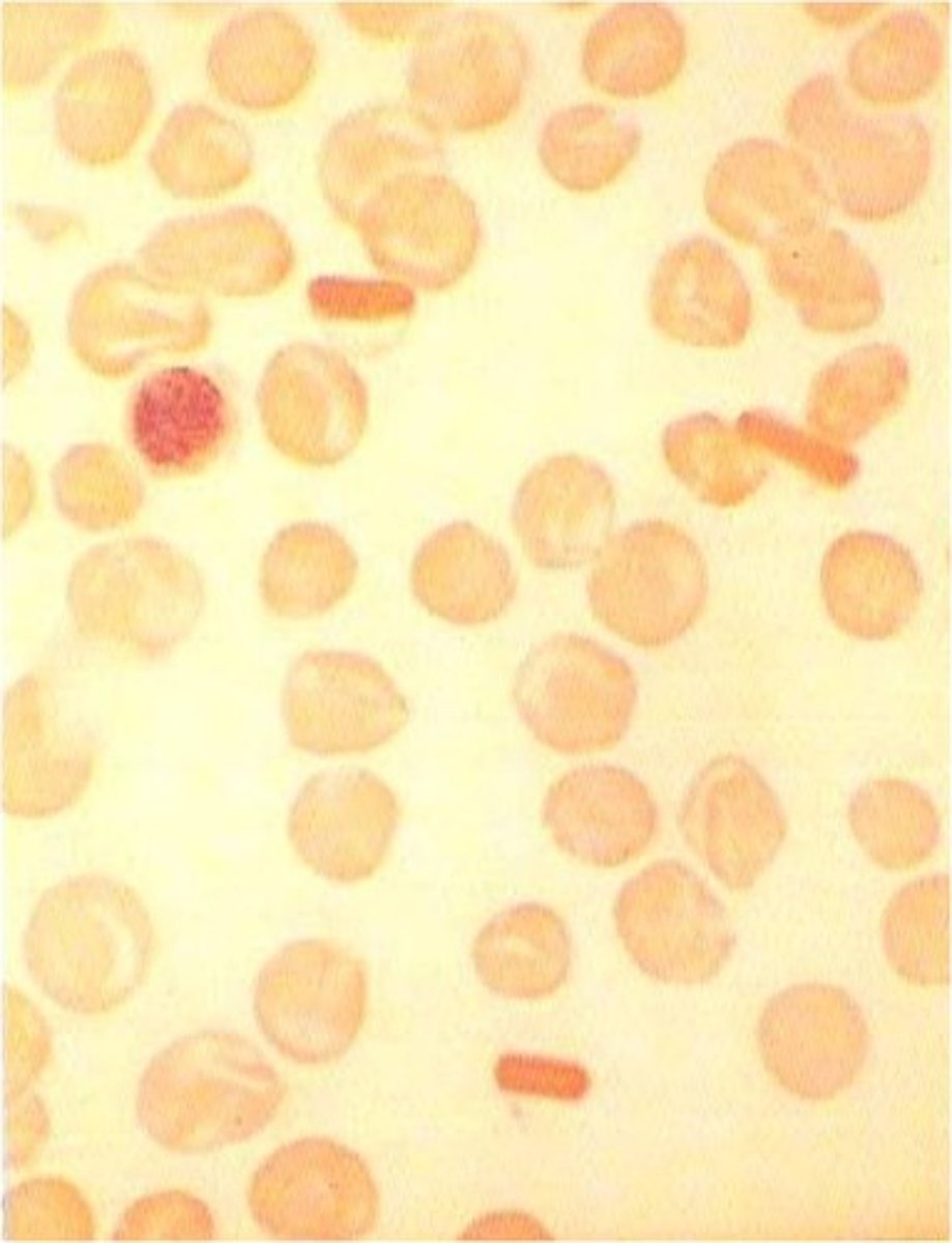 <p>- target cells<br>- slight reticulocytes<br>- Hgb C cystals<br>- negative Hgb solubility</p>