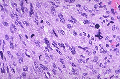 <ol><li><p>Mitotic activity in sarcoma</p></li><li><p>Abnormal mitotic feature observed</p></li></ol><p></p>