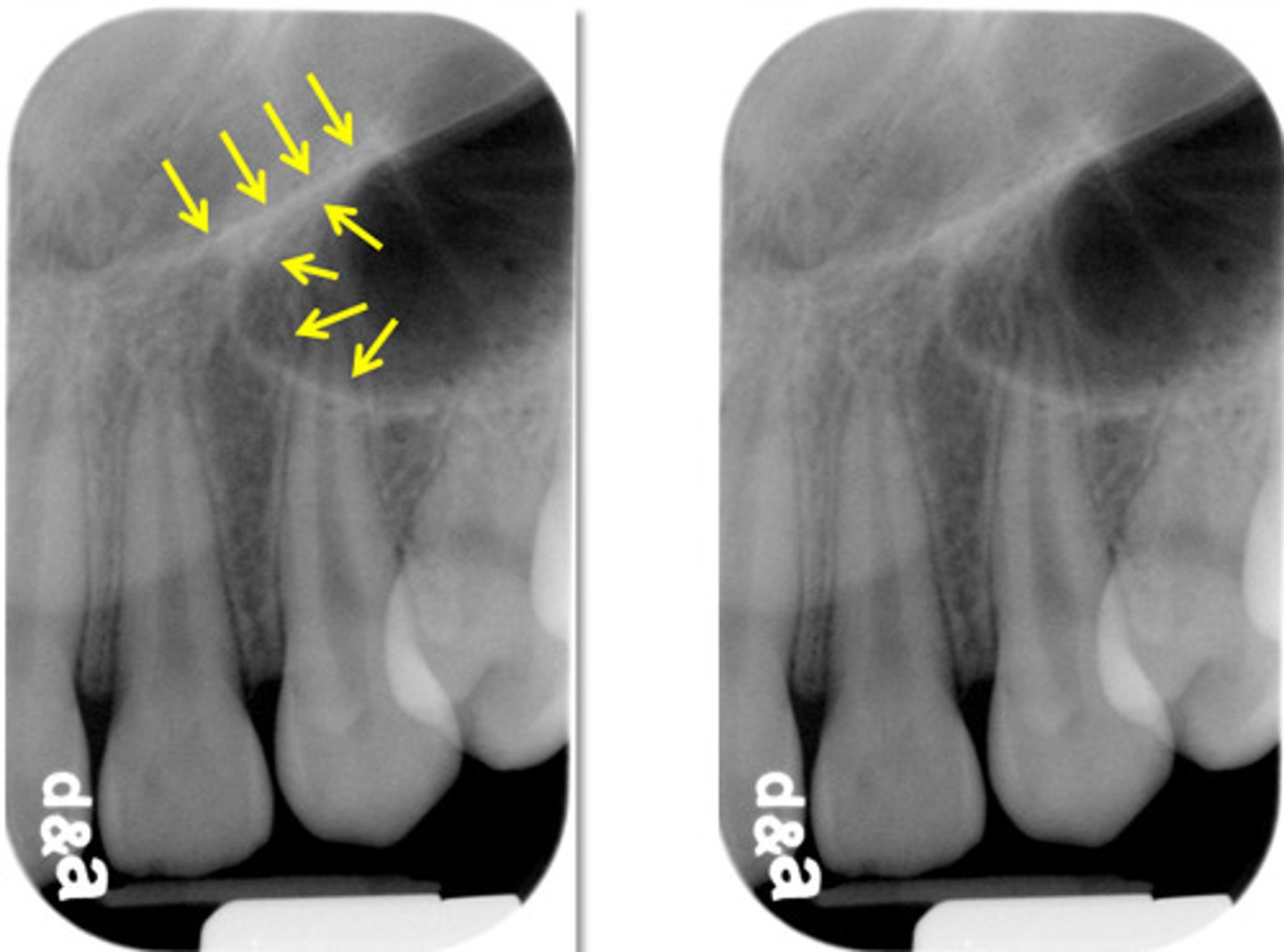 <p>Radiopaque; where the upper front wall of maxillary sinus joins with floor of nasal fossa</p>