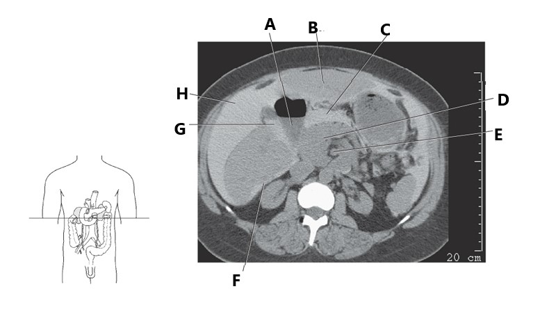 <p>Right sub hepatic</p>