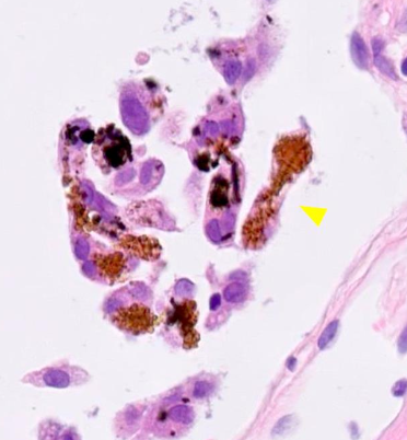 <p>Enfermedades relacionadas con el asbesto MORFOLOGÍA</p>