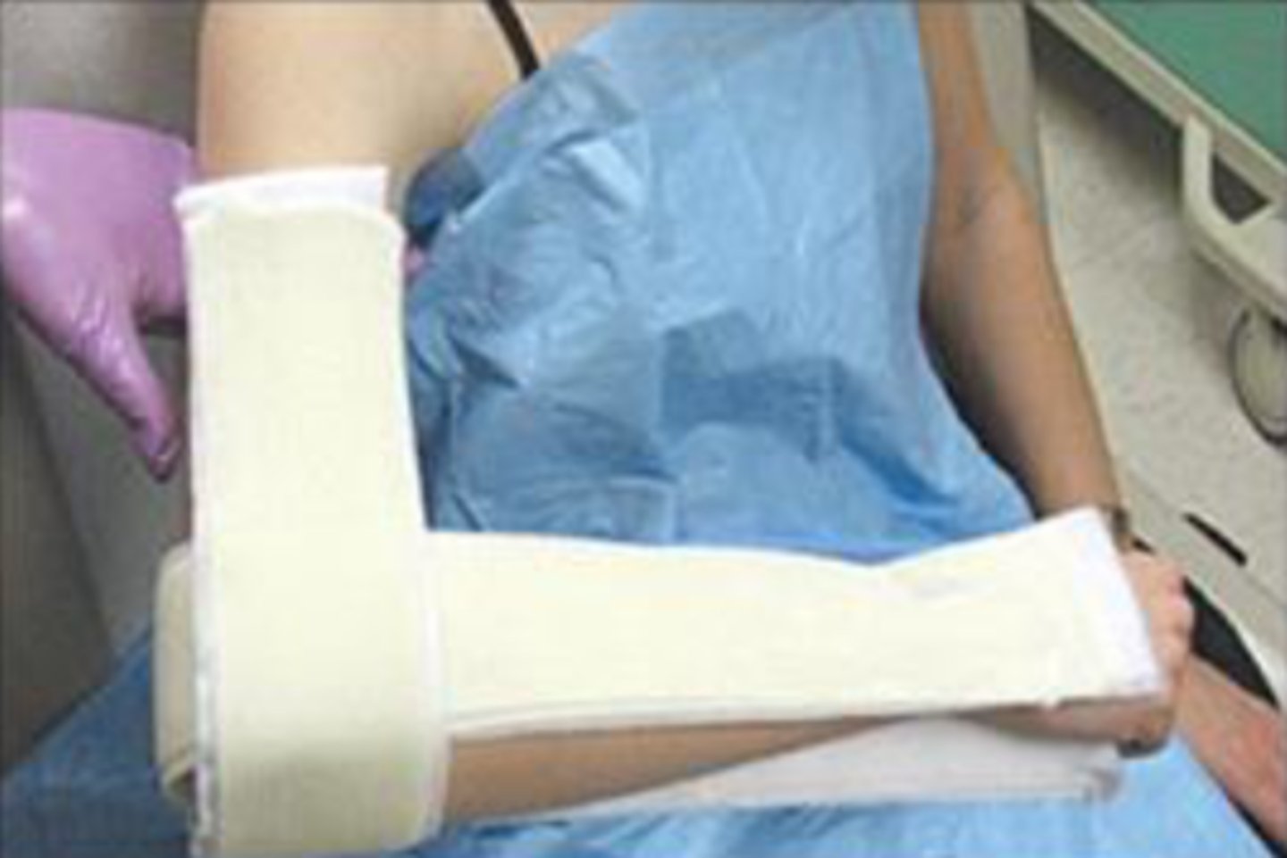 <p>sugar tong splint (distal) and coaptation splint (shaft)</p>