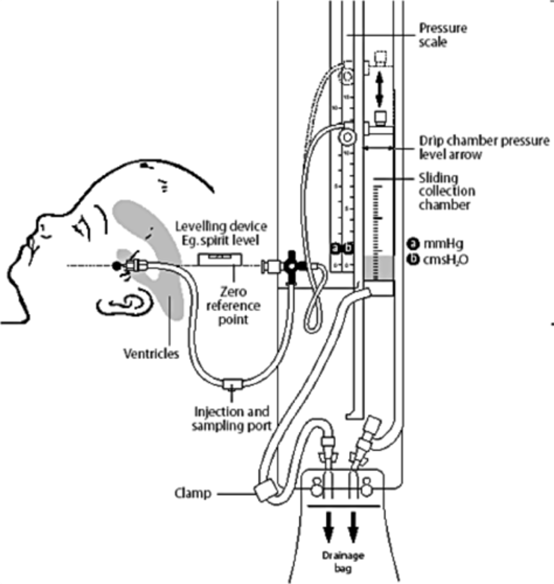 <p>External Ventricular Drain (EVD) AKA "Ventriculostomy"</p>