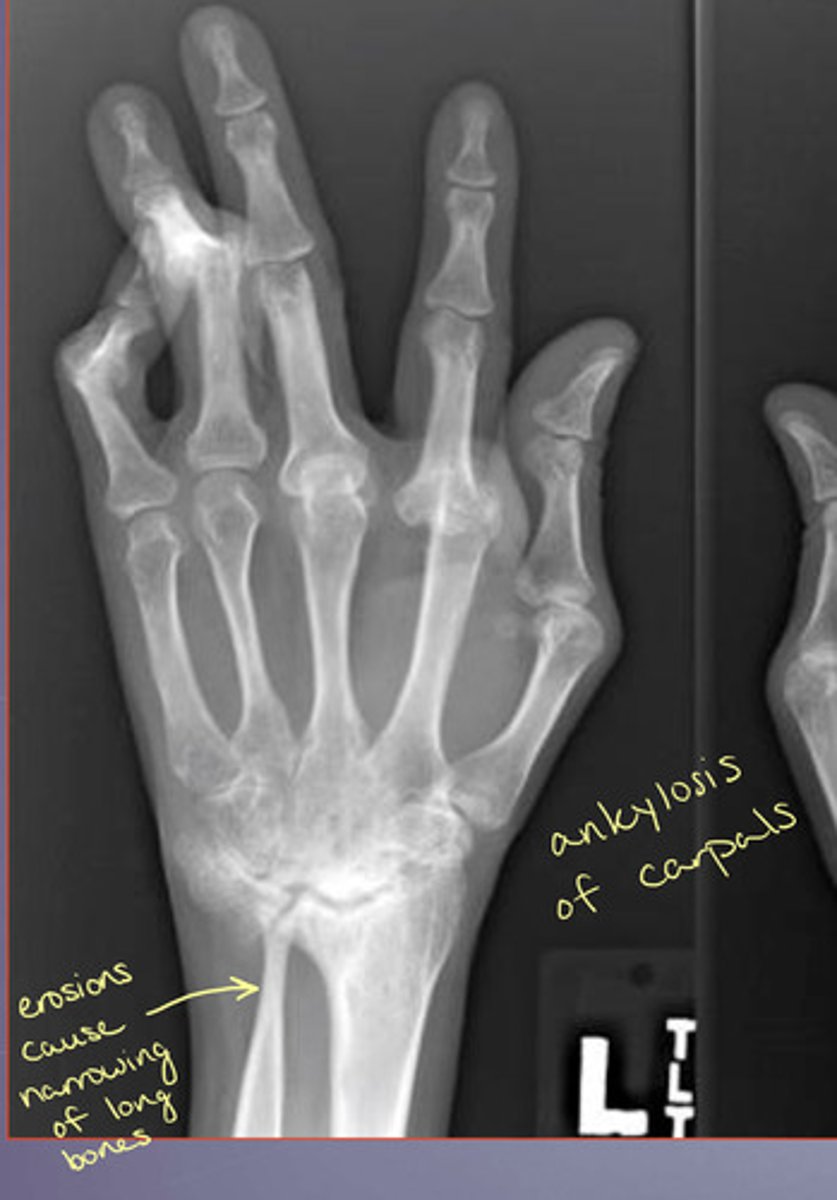 <p>Erosions can cause narrowing of the long bones</p>