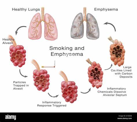 <p>emphysemea</p>