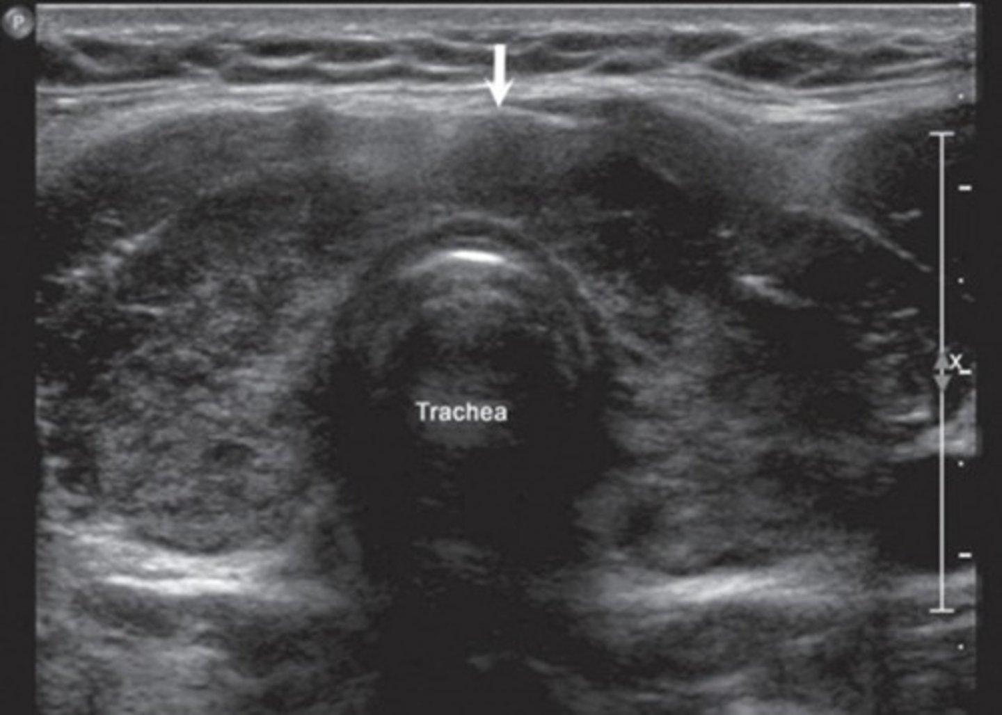 <p>Enlarged thyroid</p><p>Can be endemic or sporadic</p>