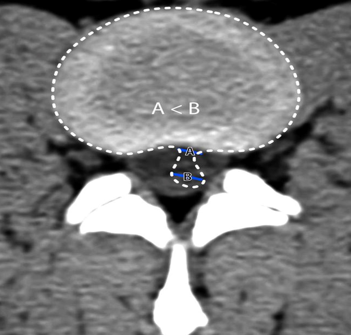 <p>Base is narrower than the herniation dome</p>