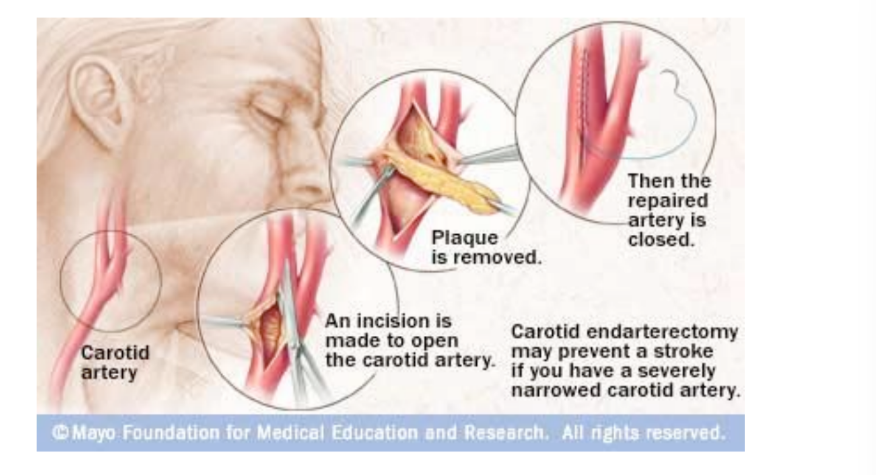 <p>Surgical procedure</p><p> Plaque is removed from the artery</p><p> Carotid is opened length-wise</p><p> Temporary shunt is placed to bypass</p><p>disease segment</p><p> Plaque is removed</p><p> Intima and media layers</p><p> Carotid is sewn back together using</p><p>a synthetic patch</p>