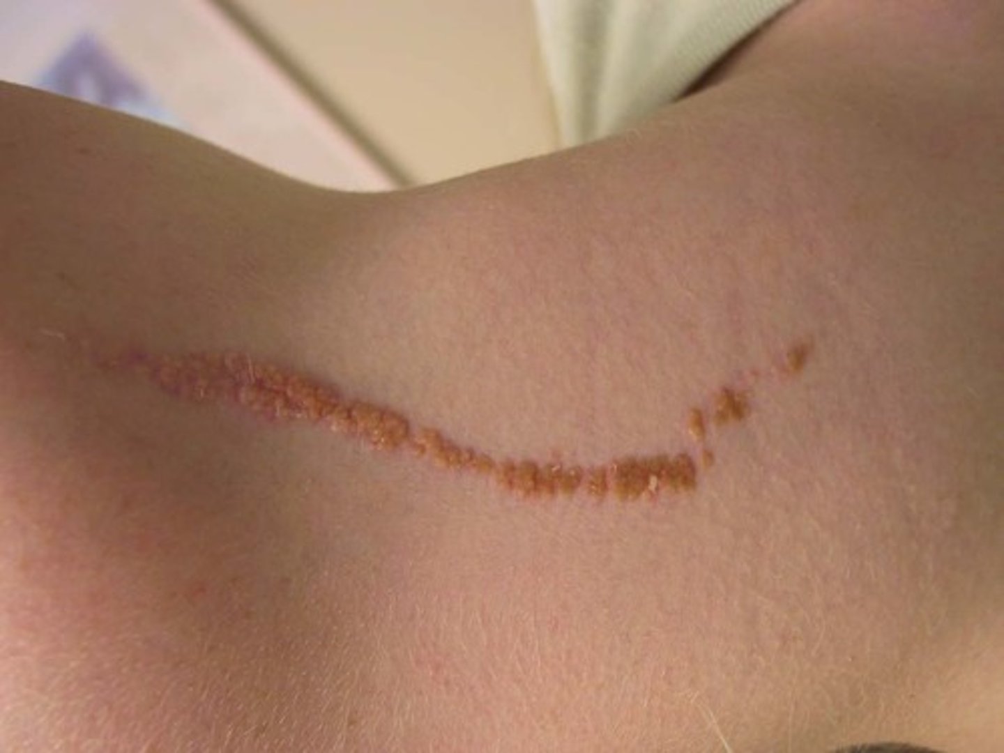 <p>lesions that appear in a straight line <br><br>Examples: lineal epidermal nervus</p>