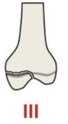 <p>Fracture running through the physis and epiphysis</p>