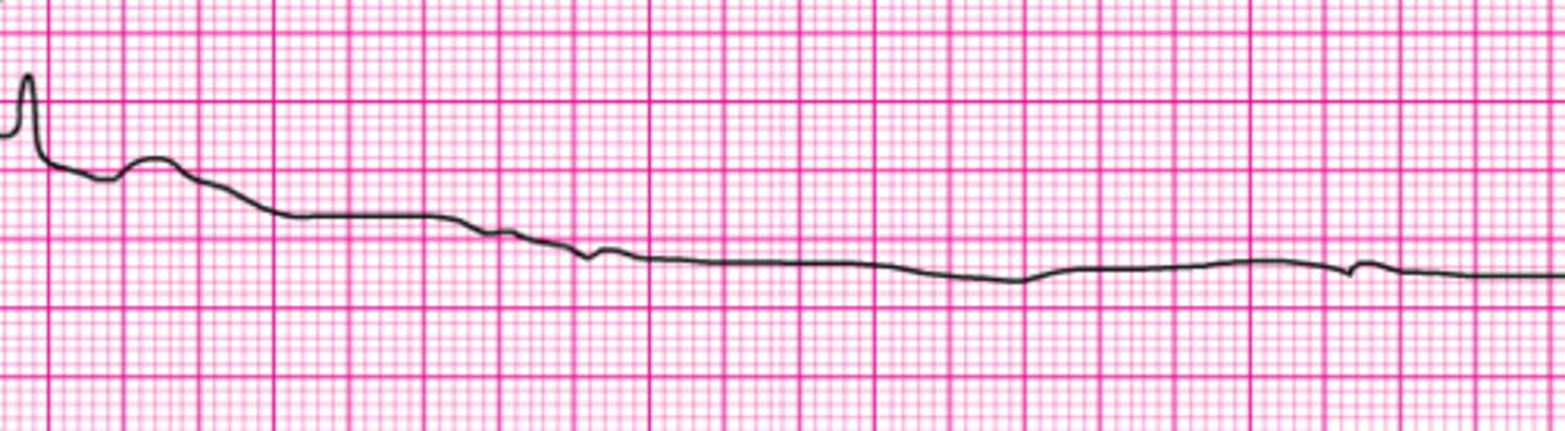 <p>Identify the rhythm.</p>