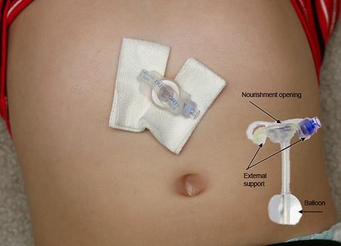 <p>Percutaneous endoscopic gastrostomy tube inserted through the abdominal wall directly into the stomach or portion of small intestine, used for long-term feeds.</p>