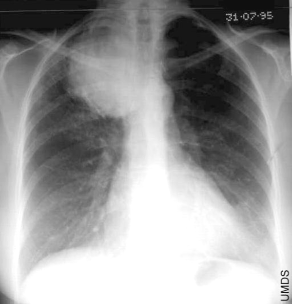 <p>What is a pancoast tumor? </p>