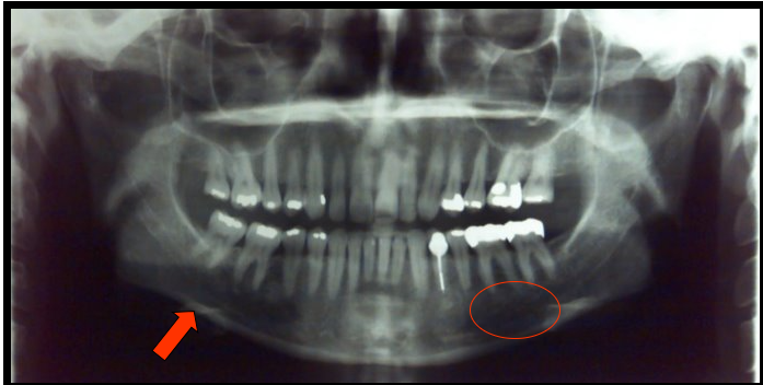 <ul><li><p><span>appears as a dense radiopaque band that outlines the lower border of the mandible.</span></p></li><li><p><span>appears as a diffuse radiolucent area in the molar region.</span></p></li><li><p><span>These landmarks can be seen on intraoral images.​</span></p></li></ul><p></p>