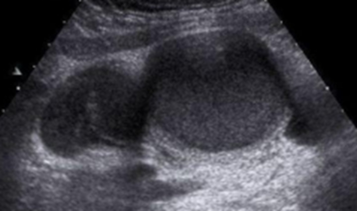 <p>Blood in FT, likely to have echoes/heterogeneous</p>