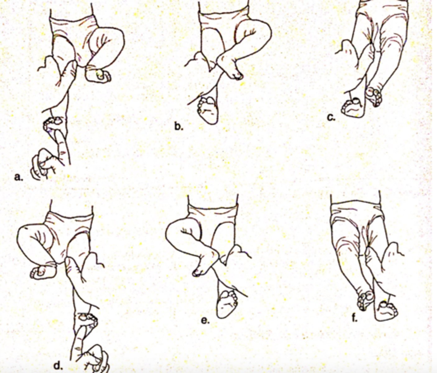 <p>pain to foot while holding LE into position, baby will pull opposite leg into flexion and add and try to push you away</p><p>- develops at 28 weeks gestation</p><p>- integrates at 1-2 months</p>