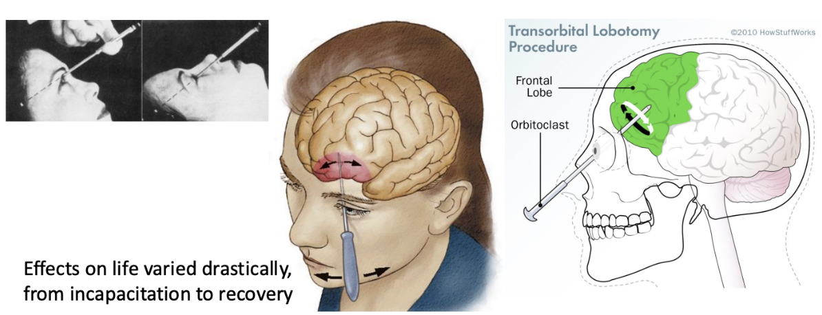 <p>NO CLEAR RESULTS of therapeutic intervention in the 20th CE. Some had little to no effect, some had moderate effect </p><p>Lobotomy is Orbitoclast (like a pick) go through nose and behind the eyes and to the prefrontal lobe and damage (swish up) that area</p><p>The guy who came up w this had the idea based on ONE study on chimpanzee that had this lobotomy (and it lost frustration during hard task) → used on ppl who have “disruptive behavior”<span data-name="face_with_raised_eyebrow" data-type="emoji">🤨</span>! So dangerous! </p>