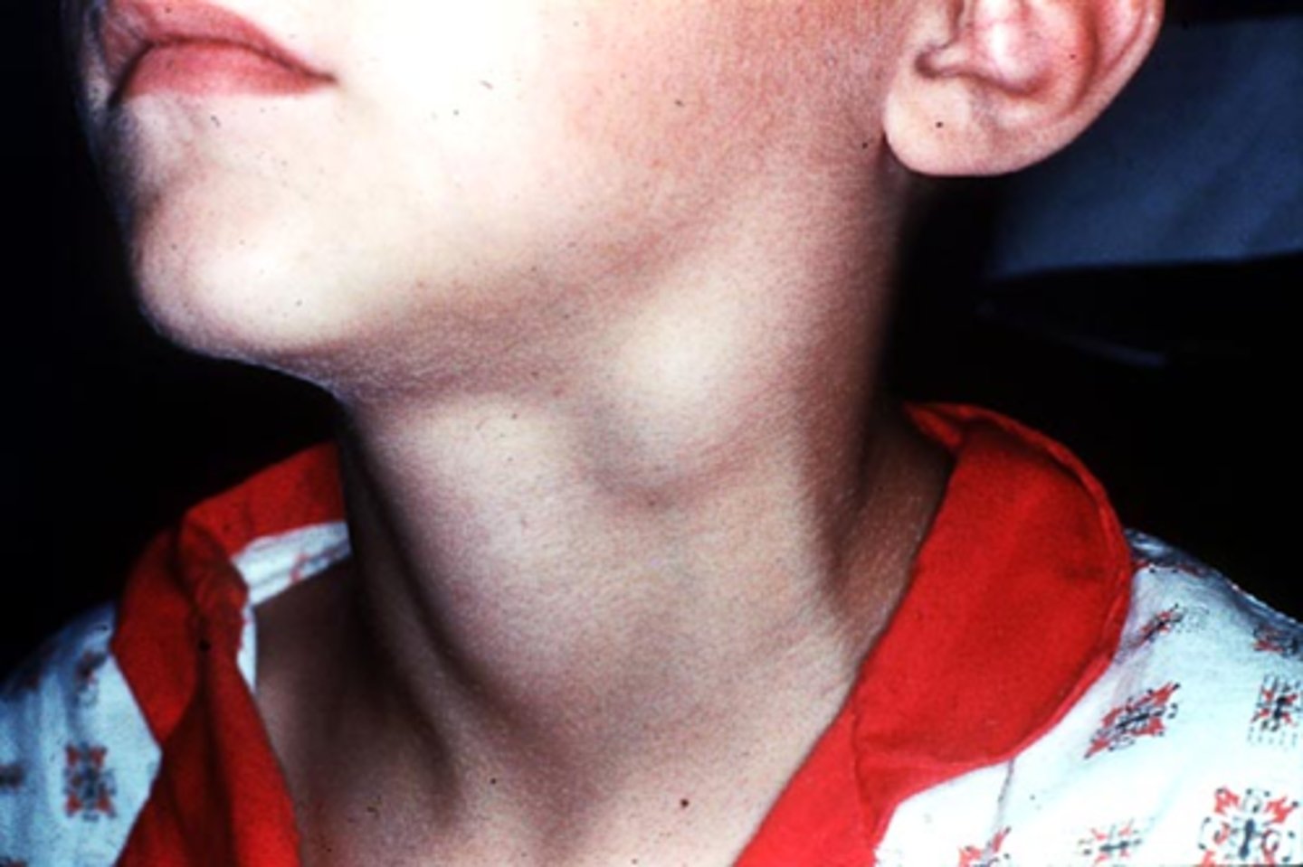 <p>lymphadenopathy (swelling of lymph nodes)</p>