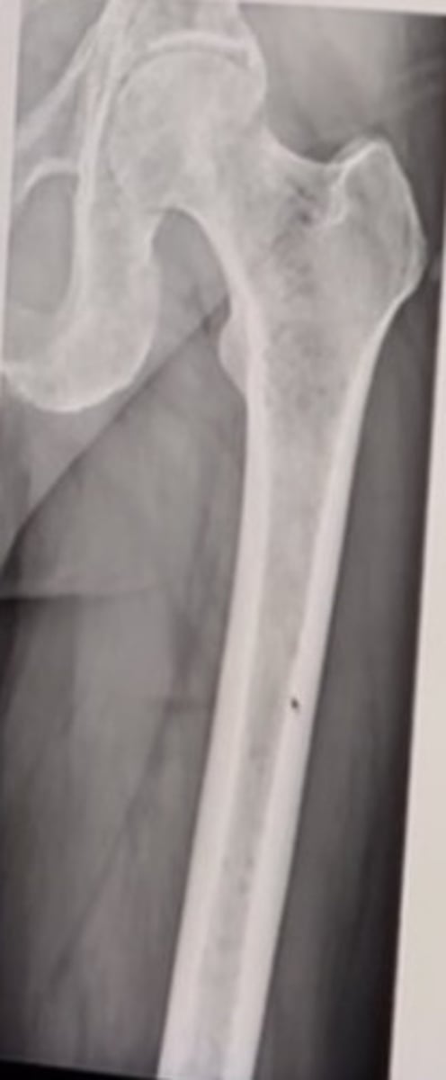 <p>54 year old male with severe fatigue.</p><p>Based on the x-ray findings seen above, what is the most likely diagnosis:</p><p>Multiple myeloma</p><p>Paget disease</p><p>Blastic metastasis</p><p>Fibrous dysplasia</p>