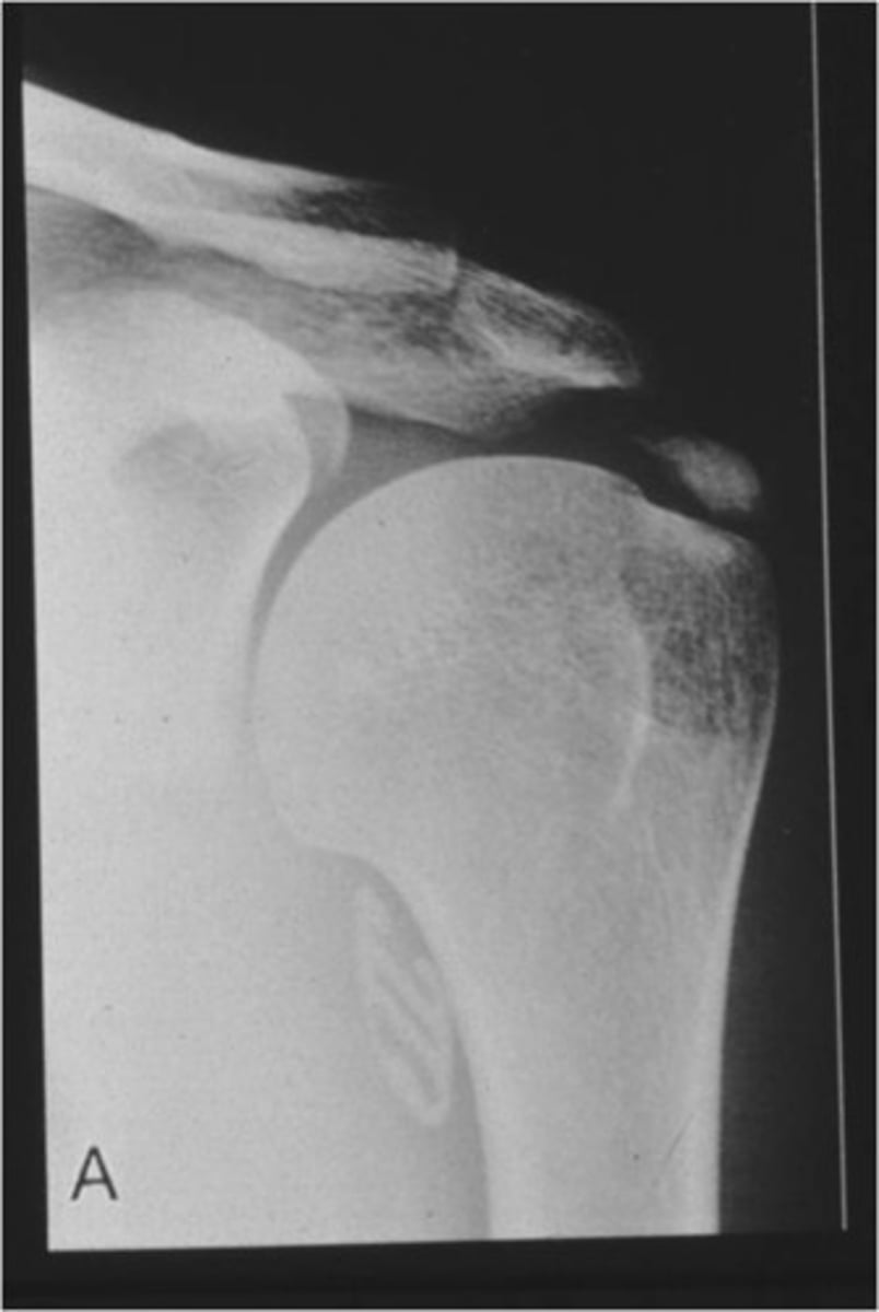 <p>Hardy crystals consisting of calcium and phosphate that form the bone matrix.</p>
